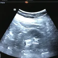 Obraz USG z widocznym zarodkiem, symbolizującym początki rozwoju medycyny prenatalnej, kiedy wynaleziono USG ciąży.