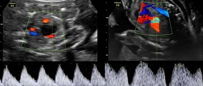 Zdjęcie USG kiedy wynaleziono - fascynująca historia ultrasonografii w medycynie