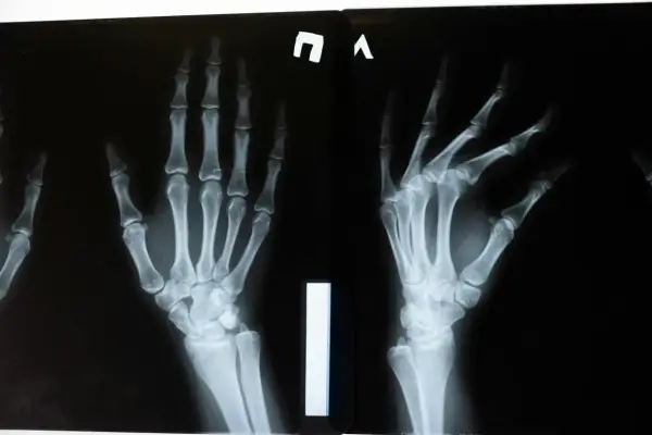 Rentgen - Od odkrycia do diagnostyki. Jak działa RTG?